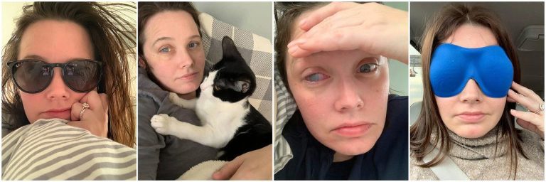 lasik eye surgery recovery